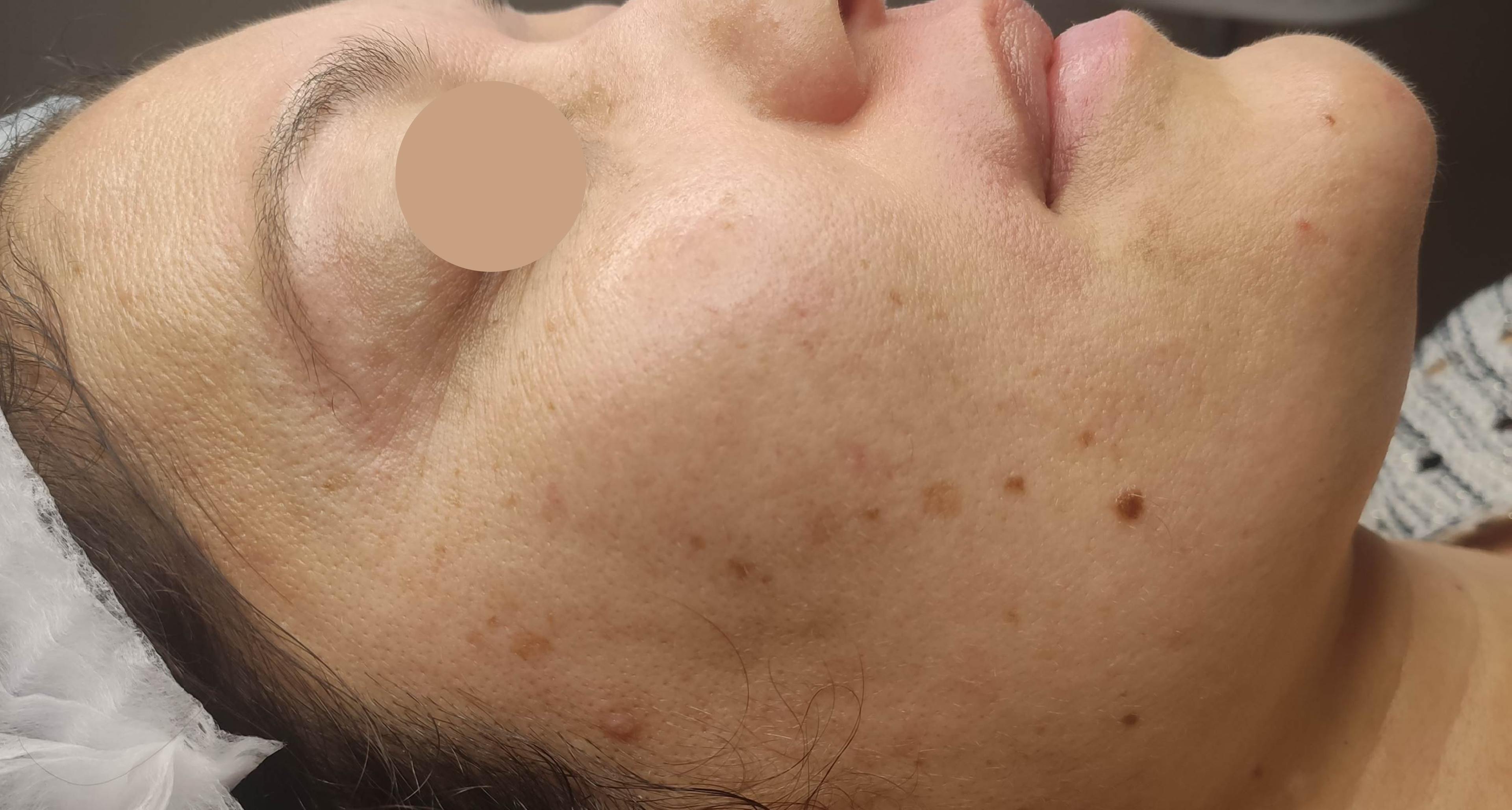 microneedling bordeaux avant apres